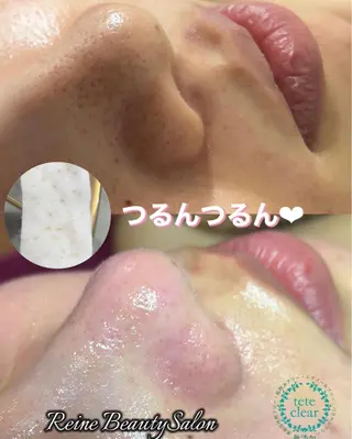 Reine BeautySalon所属・毛穴/シミ肝斑/脱毛 横山梨里のエステ・リラクイメージ