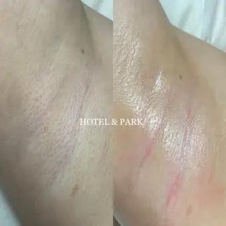 HOTEL&PARK . ワックス脱毛のエステ・リラクイメージ