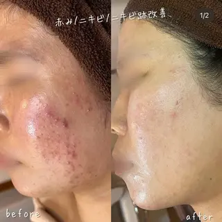 【ハーブピーリング/毛穴洗浄】NA skin 川崎店〜ニキビ・毛穴専門店〜所属・NAskin川崎 皆川のエステ・リラクイメージ