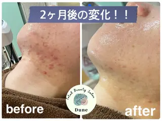 Total beauty salon Dune所属・ニキビ・肌質改善 サロンDuneのエステ・リラクイメージ