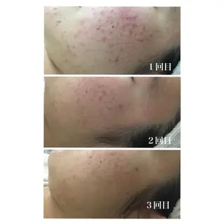 Meupニキビ専門店 背中/ハーブ/ララのその他イメージ