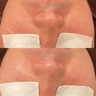 メンズ 毛穴ケア/毛穴診断/ 毛穴洗浄〔心斎橋〕のエステ・リラクイメージ