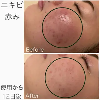 学生ニキビ改善🍀 優しい肌質改善のエステ・リラクイメージ