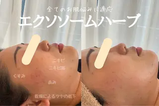 最速小顔・肌質管理 ❣️エスポワールのエステ・リラクイメージ