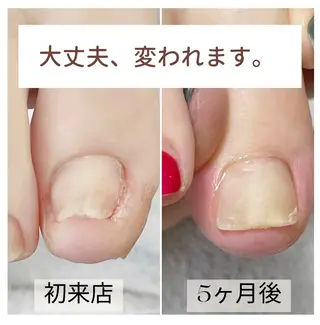 ネイル 深爪・巻き爪 専門サンセリテのネイルデザイン