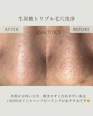 毛穴ケア・肌質改善 ENIのエステ・リラクイメージ