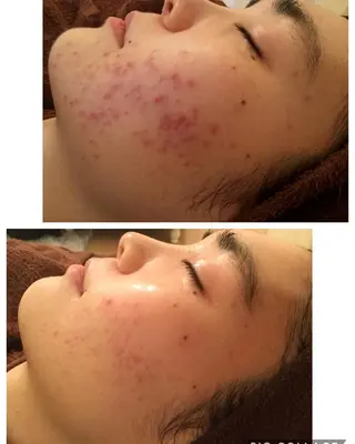 ニキビ/肌質改善専門 Snow skinのエステ・リラクイメージ