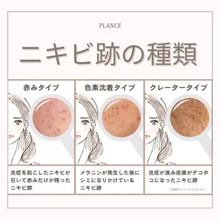 フェイシャル専門 肌質改善/プランスのエステ・リラクイメージ