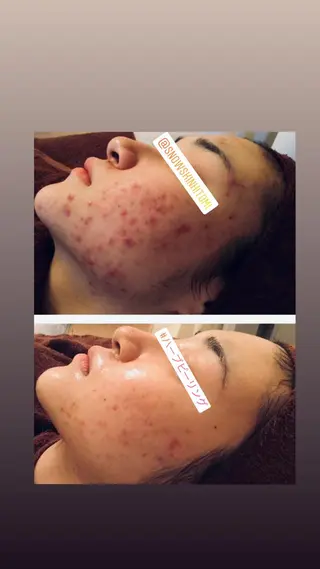 ニキビ/肌質改善専門 Snow skinのエステ・リラクイメージ