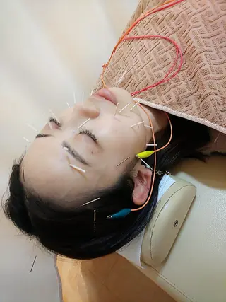 リフトアップ・たるみ ☆美容鍼小顔矯正のその他イメージ