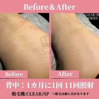 メンズ キッズ 有人型セルフサロン 脱毛/痩身/美顔のその他イメージ