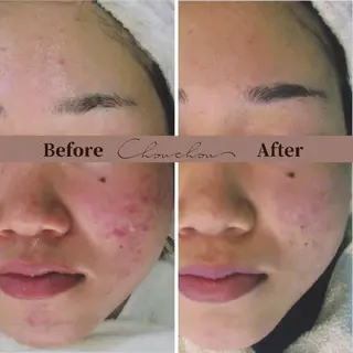 beauty & health salon Chou chou所属・ニキビ・毛穴🌿肌を 育てるララピール✨のエステ・リラクイメージ