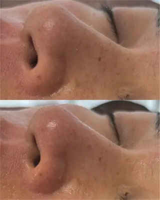 肌質改善×毛穴洗浄 ナスサロ 看護師只野のエステ・リラクイメージ