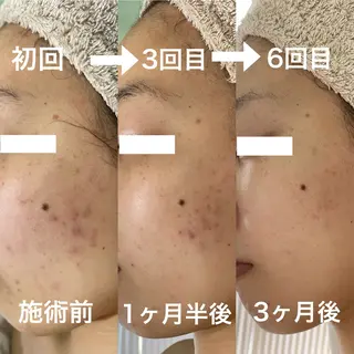 シェノン所属・毛穴/ニキビ/ ニキビ跡肌改善専門のエステ・リラクイメージ