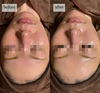 HINANO矢場町店【ヒナノ】所属・脱毛/肌改善🌿 HINANO 村田のエステ・リラクイメージ