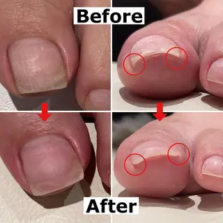 ネイル Mellow nail所属・巻爪無料モデル募集 ✨🦶MEGUMIのネイルデザイン