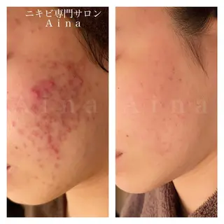 セミロング パーマ ヘアアレンジ メンズ キッズ ネイル マツエク・マツパ アイブロウ ニキビ跡専門サロン Ainaのエステ・リラクイメージ