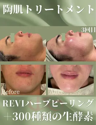 REVITA所属・元祖剥けないハーブ リヴィタのエステ・リラクイメージ