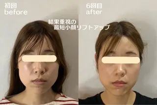 最速小顔・肌質管理 ❣️エスポワールのエステ・リラクイメージ