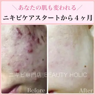 ニキビ・ 肌荒れ専門店のエステ・リラクイメージ