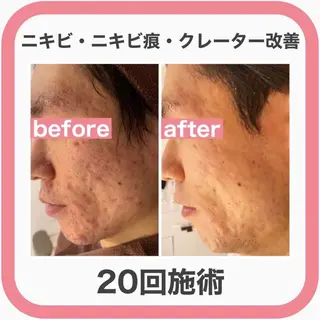 学生ニキビ改善🍀 優しい肌質改善のエステ・リラクイメージ