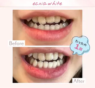 エクシアホワイト調布所属・セルフホワイトニング エクシア調布店のその他イメージ