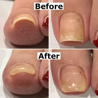 ネイル Mellow nail所属・巻爪無料モデル募集 ✨🦶MEGUMIのネイルデザイン