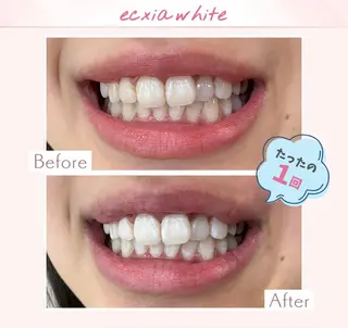 エクシアホワイト調布所属・セルフホワイトニング エクシア調布店のその他イメージ