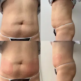 Miiju.所属・Miiju. 石巻市 脂肪冷却  鈴木のエステ・リラクイメージ