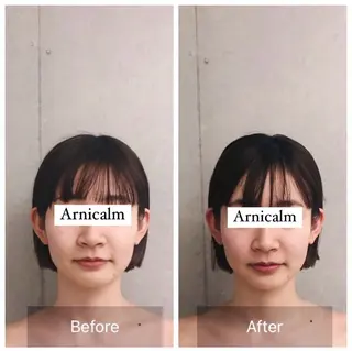 ハーブピーリング 肌再生ピーリング/のエステ・リラクイメージ