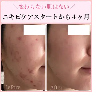 ニキビ・ 肌荒れ専門店のエステ・リラクイメージ