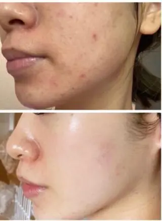 【ハーブピーリング/毛穴洗浄】NA skin 川崎店〜ニキビ・毛穴専門店〜所属・NAホワイトニング 川崎店のエステ・リラクイメージ