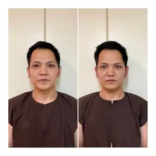 メンズ 即小顔♥️美容鍼× ハーブピーリングのその他イメージ