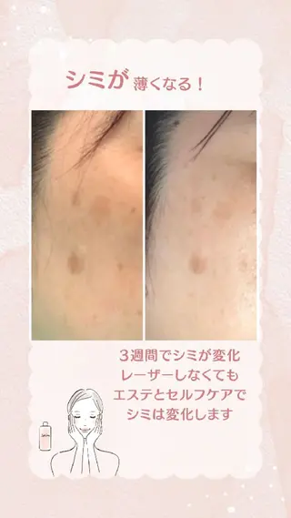 小顔エステサロン マインドール所属・泉大津エステ毛穴   シミ専門サロンのエステ・リラクイメージ