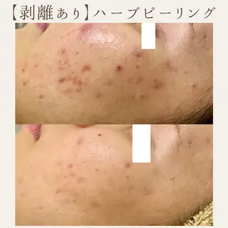 肌質改善サロン renew所属・肌質改善サロン renew/ｳｴｷのエステ・リラクイメージ