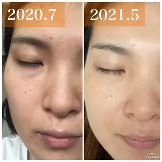 ネイル ニキビ毛穴改善 🌿ハーブピーリングのエステ・リラクイメージ