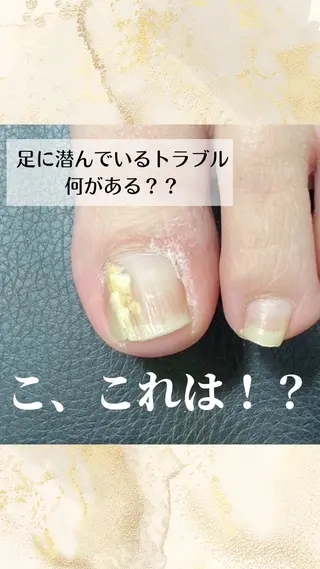 ネイル 深爪・巻き爪 専門サンセリテのネイルデザイン