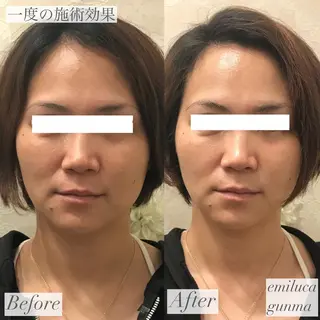 emiluca西目/ 毛穴洗浄/細胞美容のエステ・リラクイメージ