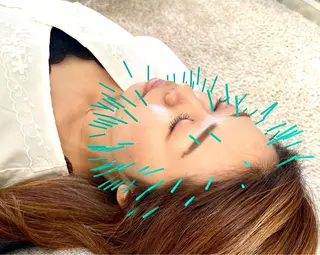 美容鍼灸サロン　TIARA所属・鍼灸サロン TIARA　美容鍼のエステ・リラクイメージ