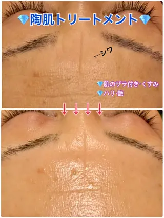 【リベルハーブピーリング認定店】敏感肌・美白脱毛専門店Dione立川店所属・Dione 立川店のエステ・リラクイメージ