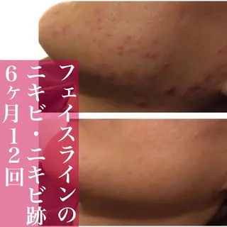 学生ニキビ改善🍀 優しい肌質改善のエステ・リラクイメージ