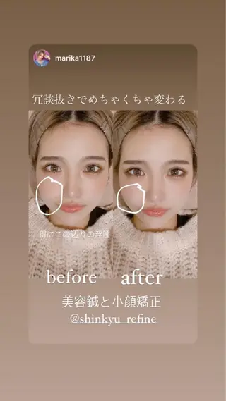 鍼灸整骨院Refine所属・鍼灸 Refineのその他イメージ