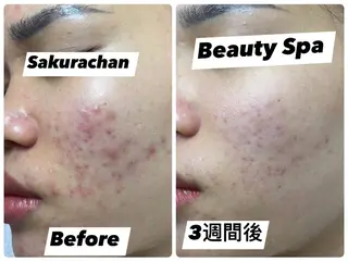 ニキビ、痩身、脱毛、 サクラチャンスパのエステ・リラクイメージ