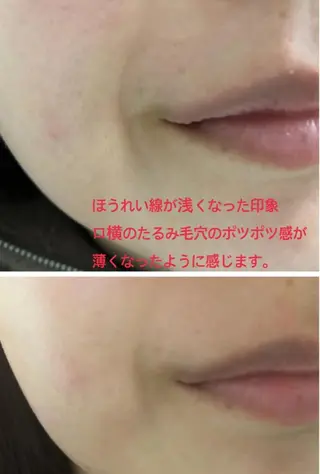 ハイフ リンパ 毛穴 ダフネ 六本木のエステ・リラクイメージ