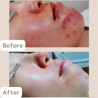 レチノール/ニキビ/ 毛穴ケア 浅川のエステ・リラクイメージ