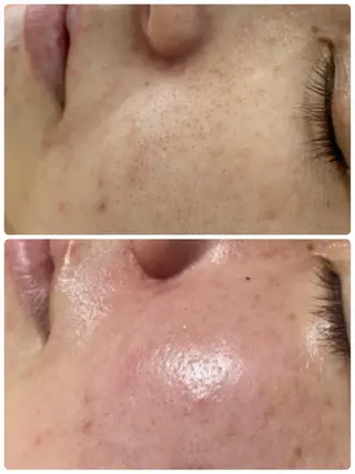 Chalon所属・REVI取扱・肌悩み 毛穴Chalonのエステ・リラクイメージ