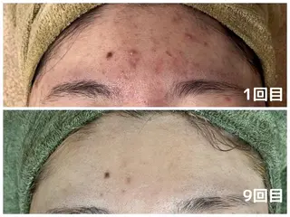 韓国美肌/肌質改善 【天神】yuiのエステ・リラクイメージ