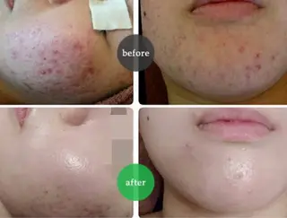 ☺ハーブピール💕 ソフィアカロン💖のエステ・リラクイメージ