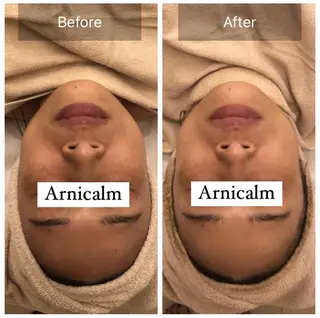 ハーブピーリング 肌再生ピーリング/のエステ・リラクイメージ