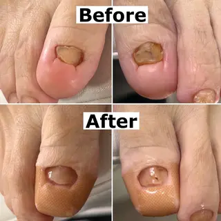 ネイル Mellow nail所属・巻爪無料モデル募集 ✨🦶MEGUMIのネイルデザイン